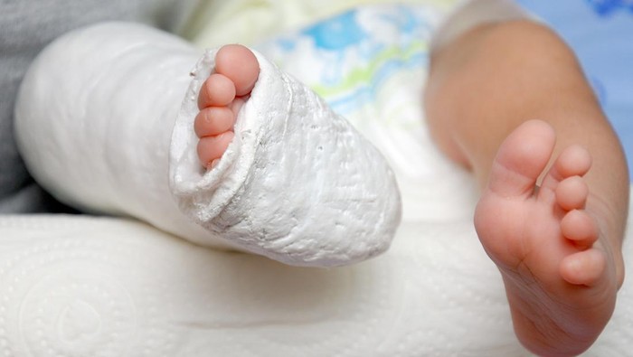 1763960661769-ilustrasi-balita-patah-tulang_169