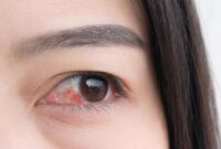 1765429488074-ilustrasi-mata-merah-atau-konjungtivitis-atau-iritasi-mata-sensitif_169