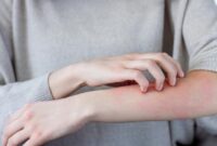 1766012655359-ilustrasi-ruam-kulit_169