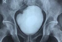 1767999863143-pria-32-tahun-ngeluh-nyeri-perut-ternyata-ada-batu-kandung-kemih-sebesar-ini-1750239492772_169