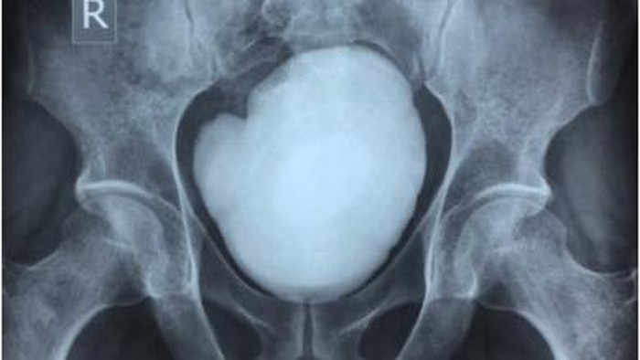 1767999863143-pria-32-tahun-ngeluh-nyeri-perut-ternyata-ada-batu-kandung-kemih-sebesar-ini-1750239492772_169